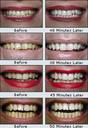 teeth whitening denver