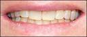 lincoln teeth whitening